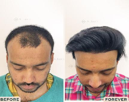 Best Leading Hair Transplant Surgeon in Gurugram 