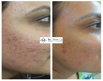 Best Skin Treatments Clinic in Greater Kailash