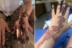 how long does black henna reaction last, black henna tattoo burns, henna tattoo cause aussie woman to almost lose her hand, Tattoo