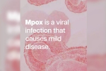 mpox in Africa, health emergency, mpox emergency again, Mpox mpox in Africa, health emergency, mpox emergency again, Mpox