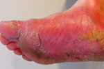 home remedies for athlete’s foot, athlete’s foot home remedies, top 7 home remedies for athlete s foot, Tea tree oil