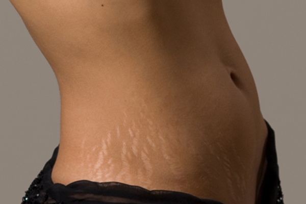 Tips to get rid of stretch marks},{Tips to get rid of stretch marks